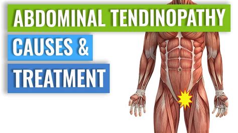 Abdominal Tendinopathy - Causes and Treatment, Including Exercises - YouTube