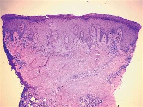 Right ankle biopsy showing a lichenoid dermatitis with superficial and... | Download Scientific ...