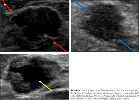 Fibroadenoma : From Imaging Evaluation to Treatment | Semantic Scholar