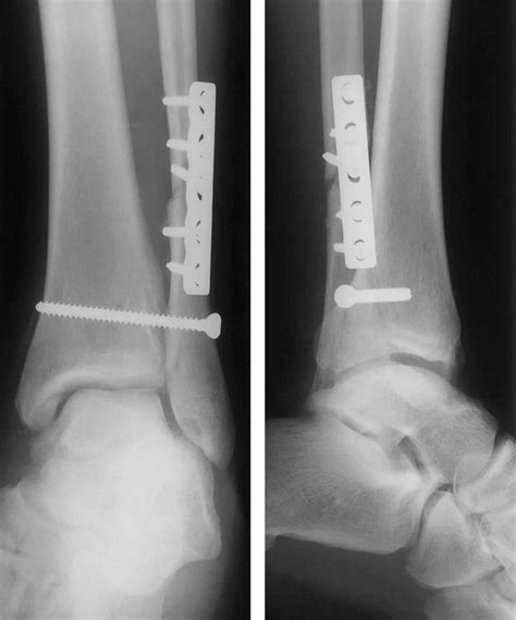 Transverse fracture & transverse process fracture causes & treatment