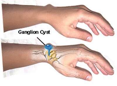 Ganglion Cyst at Wrist & Foot - Pictures, Causes, Treatment, Removal