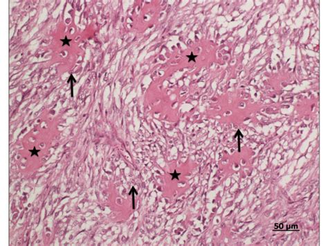 Osteosarcoma Histology Labeled