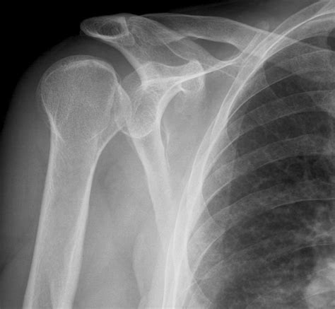 POSTERIOR SHOULDER DISLOCATION | Buyxraysonline