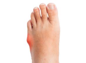 Bunionette (Tailor's Bunion) - Perform Podiatry