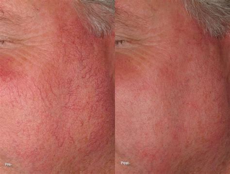 Facial Redness Treatment minneapolis - Zel Skin & Laser Specialists ...