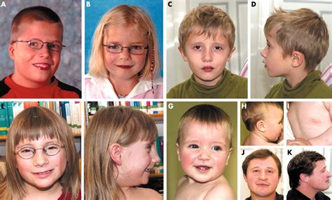 TECNOLOGIAS Y RECURSOS: SÍNDROME VELOCARDIOFACIAL