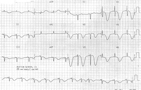 Killer ECG Patterns • LITFL Medical blog • ECG Library