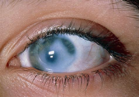 Congenital glaucoma in teenage girl - Stock Image - M155/0127 - Science Photo Library