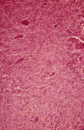 Peripheral Ossifying Fibroma Histology