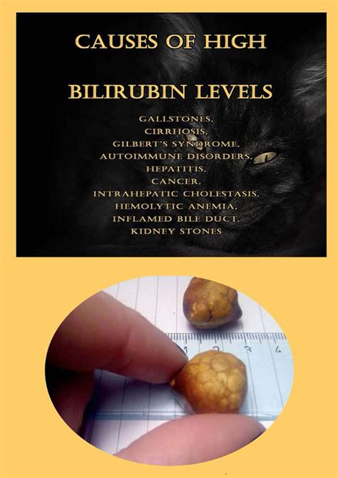 Buy Causes Of High Bilirubin Levels: Gallstones, Cirrhosis, Gilbert’s Syndrome, Autoimmune ...