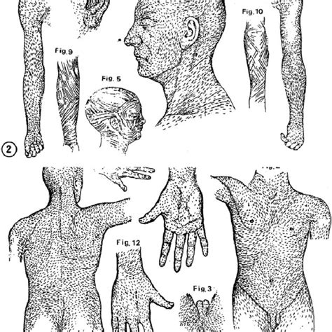 (Left) Perfect scar after " clamshell incision " for lung... | Download ...