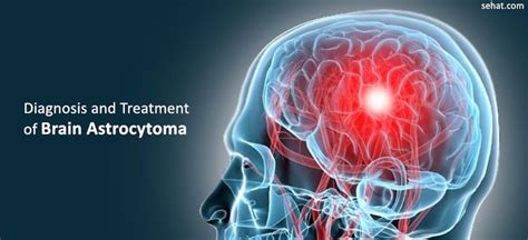 Diagnosis And Treatment Of Brain Astrocytoma In German Hospitals