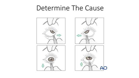 Orbital complications of zygomaticomaxillary complex fracture | PPT ...