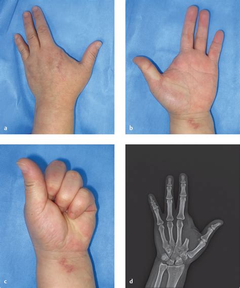 Failed Replant: Ray Amputation | Musculoskeletal Key