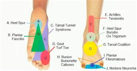 Taking A Look At Chronic Foot Pain - What Causes Foot Pain