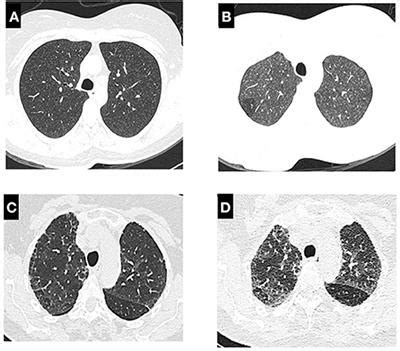 Frontiers | Hypersensitivity Pneumonitis: Diagnostic and Therapeutic Challenges