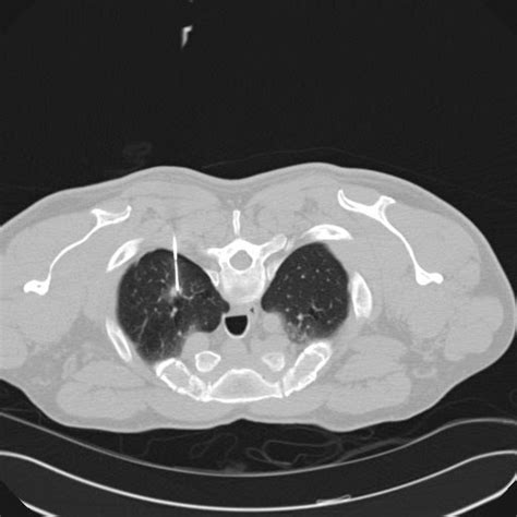 Radiology Cases: 7mm Nodule Lung Biopsy