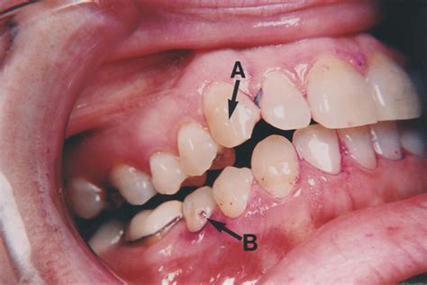 Photo Scanner: Tuberous Sclerosis Complex