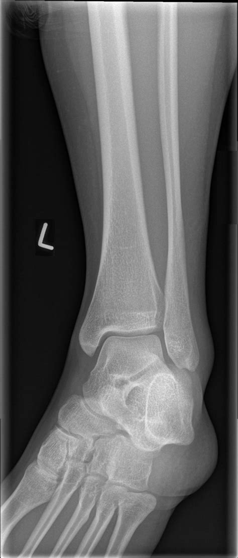 EMRad: Radiologic Approach to the Traumatic Ankle