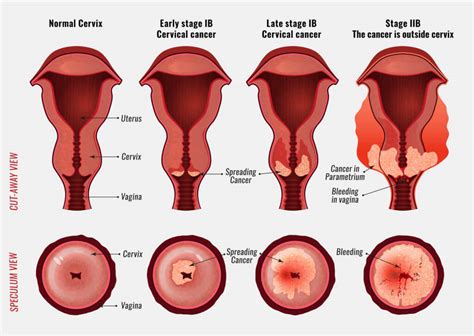 Cervical Cancer - Gynecologic Oncology | Singing River Health System