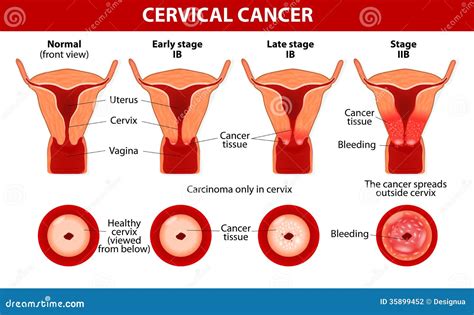 Cervical Cancer. Carcinoma Of Cervix Stock Photography - Image: 35899452