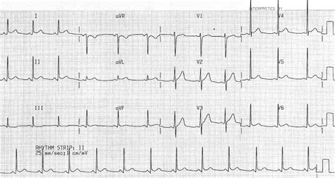 Pericarditis ECG Changes • LITFL • ECG Library Diagnosis