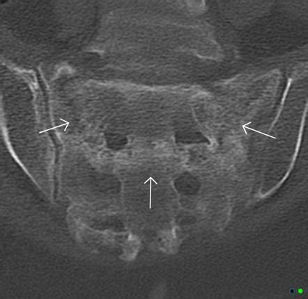 Sacral insufficency fractures | Radiology Case | Radiopaedia.org