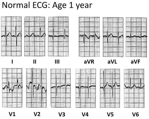 Paediatric ECG Interpretation • LITFL • ECG Library Basics