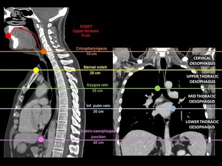 Lateral View Chest Anatomy Esophagus