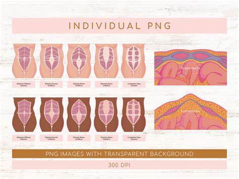 Diastasis Recti Variations Diagram Abdominal Muscles Separation Linea Alba PDF JPG PNG & Canva ...