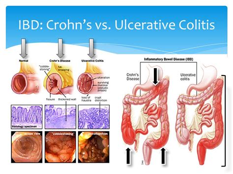 Crohn's Disease Vs Ulcerative Colitis