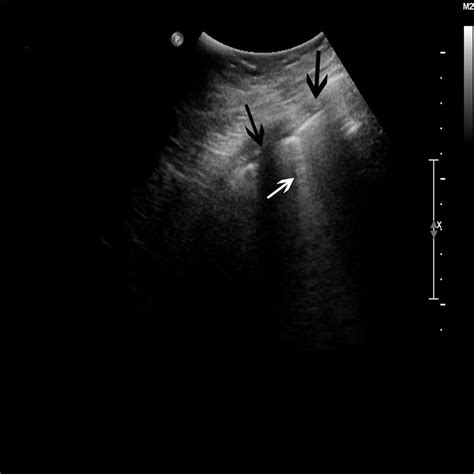 Image: Comet Tail Artifact - MSD Manual Professional Edition