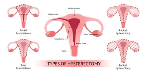 Imagens vetoriais Histerectomia | Depositphotos