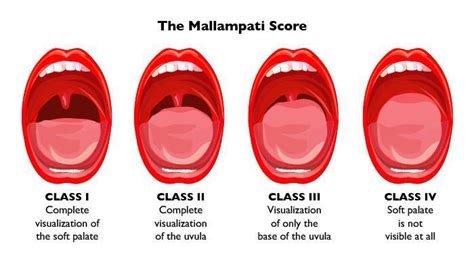 Mallampati Score And Predicting Sleep Apnea: Ultimate Guide Updated 2024