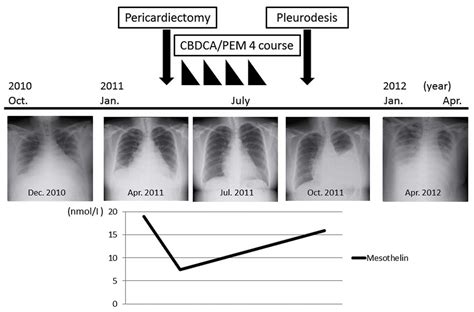 Primary malignant pericardial mesothelioma with increased serum ...