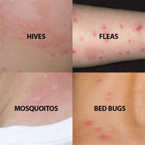 bed bug bites what do they look like - BC Bed Bug Expert