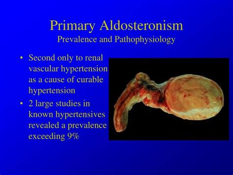 PPT - Hypertension associated with Endocrine Disorders PowerPoint ...