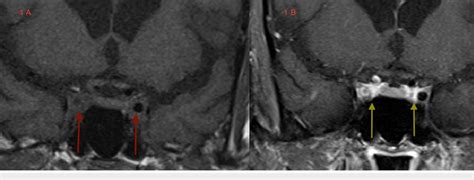 Coronal T1-weighted MRI images. 1A -unenhanced images show carotid ...