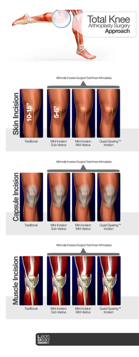 Total Knee Arthroplasty Surgery Approach - Naples Orthopedic Doctor | Leon Mead MD