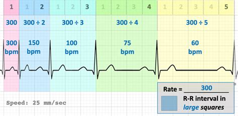 How to calculate hr on ekg - The Tech Edvocate