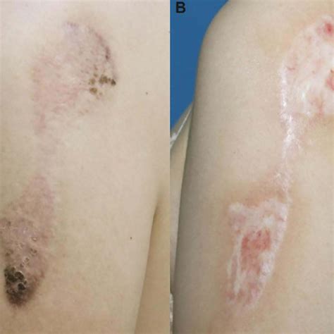 Total Patient-Reported Scores of Keloids on Different Body Parts Before ...