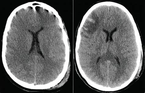 Diffuse Axonal Injury: A Devastating Pathology | IntechOpen