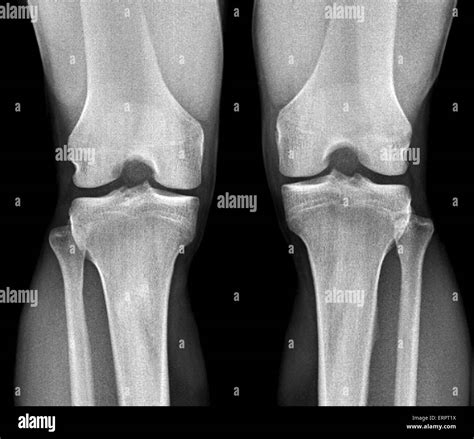 Normal knee x ray hi-res stock photography and images - Alamy