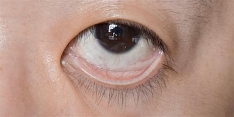 Iron Deficiency Eyes – mayepcocbetong