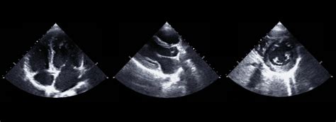 Pharmacological & Exercise Stress Echocardiography | Cranlea