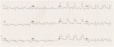 Ostial LAD (Left Anterior Descending Artery) Occlusion (Septal STEMI ...