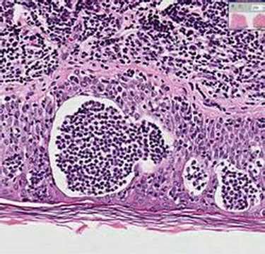 Histopathology Skin--Mycosis fungoides - YouTube