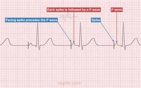 Ecg Interpretation Electronic Pacemaker Spikes Ekg | SexiezPix Web Porn