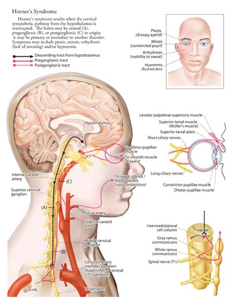 Horner's Syndrome - Physiopedia