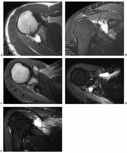 Ultrasound-Guided Injection Technique for Suprascapular Nerve Block | Anesthesia Key